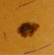 melanoma-1