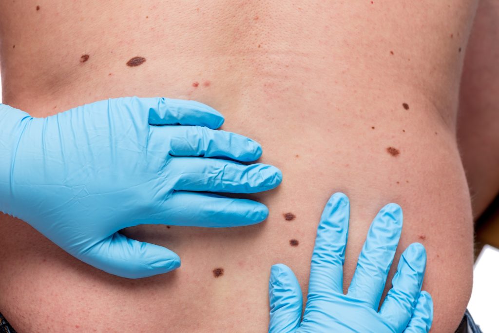 New Melanoma Treatments Are Saving Lives