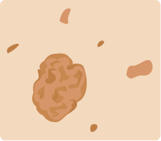 melanoma illustration