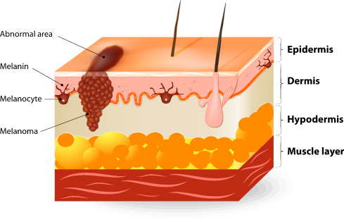 melanoma infographic